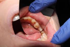 Image result for Periodontal Abscess