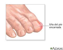 El Pie Podologia Una Encarnada Onicocriptosis Presente Cuando El Borde De La Una Se Incrusta Dentro Del Borde Interno O Externo Del Dedo Del Pie Mostrando Caracteristicas Como Dolor Enrojecimiento E