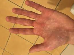 Warum Habe Ich Weisse Flecken Auf Der Hand Computer Gesundheit Und Medizin Gesundheit