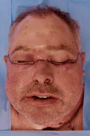 Notre bilan social, c'est aussi cette capacité à prendre des décisions fortes quand elles sont. Face Transplantation Anesthesia And Other Organizational Considerations Springerlink