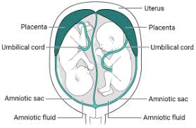 Image result for Multiple Gestation