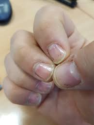 Bild Striche Linien Auf Unter Dem Nagelkrankheiten