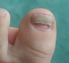 You'll receive email and feed alerts when new items arrive. Weird Toenails Picture Included March 2014 Babies Forums What To Expect