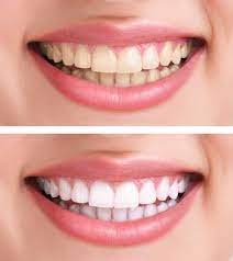 This could last from a few days to a week • if sensitivity is uncomfortable, stop and reduce time and/or frequency of treatment. Zoom Whitening In Buffalo Ny Teeth Whitening Dentist Douglas Hamill