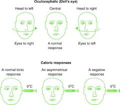 Image result for Oculovestibular Testing