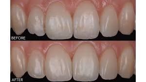 Minimally invasive solution for fluorosis and enamel hypoplasia