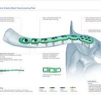 Superior Anterior Distal Clavicle Locking Plate,Medical ...