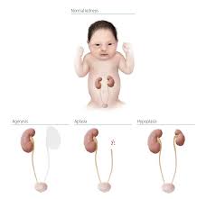 4 8 Congenital Malformations Of Genital Organs Hypospadias Q54 0 Q54 9 Ncbddd Cdc