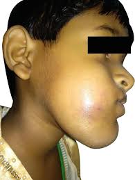 Combined Vascular Malformation