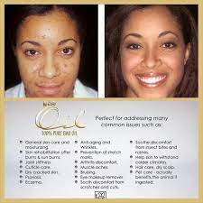 My Skin Care Regime I Use Iaso Oil The End Go Find It Www Totallifechanged Com 5747931 Total Life Changes Tlc Emu Oil