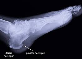 Symptoms of heel spurs can include: Heel Spurs Symptoms Causes Cures Exercises Liebscher Bracht