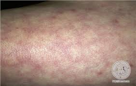 Reasonably Well Sjogren S Syndrome And Livedo Reticularis