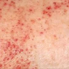 Don't buy before you see this. Treating Clients With Petechiae Ascp Skin Care Professionals