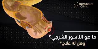 هيموكيور #1 في مصر لعلاج البواسير بالليزر | د. محمد مجدي النجار