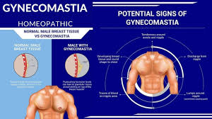 A lump or swelling, which is often (but not always) painless. Gynecomastia Enlarged Male Breast Lump Tissue Symptoms Causes Best Medicines Homeopathic Treatment Cure Without Operation