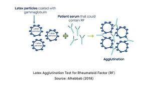 Image result for Rheumatoid Factor