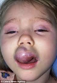 Cherry angioma marks can be removed with cryotherapy, a procedure that uses extreme cold to destroy unwanted tissue. Girl Smiles After Operation Removed Tumour The Size Of Kiwi From Her Face Daily Mail Online