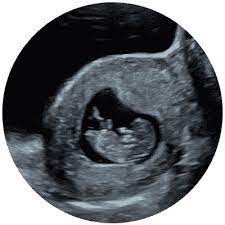 The office note usually starts with patient here for viability/dating ultrasound. Early Scans From Just 6 Weeks Window To The Womb Firstscan