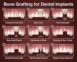 Bone Grafting Maxillofacial