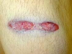 You may need to take sponge baths for several days until your wound has healed enough to shower. Do You Need More Or Less Than 13 Stitches For A Grazed Bullet Wound On Your Arm Quora