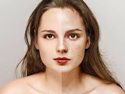 But, they can help reduce the appearance of such spots. 10 Incredible Home Remedies To Remove Freckles On Face