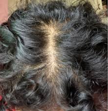 Androgenetic alopecia is the most common type of hair loss, affecting more than 50 million men and 30 million women in the united states. Androgenetic Alopecia Or Telogen Efflvium What Is My Diagnosis Donovan Hair Clinic