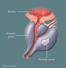 Image result for Prostate Cancer