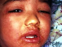 Scarlet fever: Causes, Treatment, and Outcome — DermNet