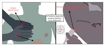 Cureus Application Of Lung Ultrasound In Critical Care