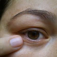 Masca Uimitoare Care Elimina Imediat Cearcanele Si Ridurile Din Jurul Ochilor Cearcăne Mască Albirea Pielii