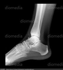 Image result for Ankle XRay