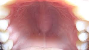 Mouth can be very much complicated especially when it comes to the issues to do with the hard palate. Torus Palatinus Pictures Symptoms And Treatments