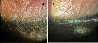 Image result for Demodex brevis