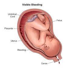 The amount of weight a woman should gain during pregnancy depends on her body mass index (bmi) prior to becoming pregnant. Complications Of Pregnancy