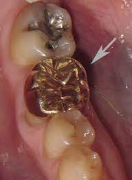 Most times, the high price is more dependent upon the laboratory than the dentist's labor. A Comparison Of Dental Crown Materials Portland Or Dr Martha Rich Dmd A Comparison Of Dental Crown Materials Dentist Portland Or