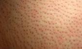 Folliculitis After Laser Hair Removal Treatment