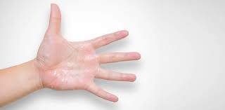 Image result for Hyperhidrosis Causes
