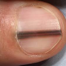 These findings do not imply the presence of renal disease and do not require further investigation. 9 Things Your Fingernails Reveal About Your Health The Active Times