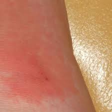 Image result for erysipel photos)