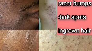 Those are ingrown hair which is often a result of frequent waxing, shaving and using various methods for removing hair on a regular basis. How To Get Rid Of Razor Bumps Dark Spots And Ingrown Hair Youtube