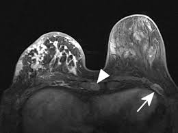 A breast mri (magnetic resonance imaging) is a test that is sometimes performed along with a screening mammogram in women with at least a 20% lifetime risk of developing breast cancer. Epos Trade