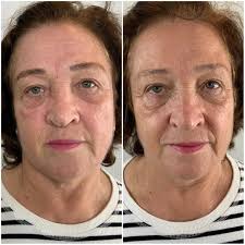 הדרכה מצויינת של פרופסור דניאל קסוטו 👨🏼‍⚕️💉