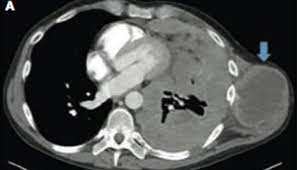 2 and chrysotile, crocidolite or amosite asbestos are the three main types of asbestos that cause mpm. Heritable Mutations May Indicate Responsiveness To Platinum Chemotherapy In Malignant Mesothelioma Center For Cancer Research