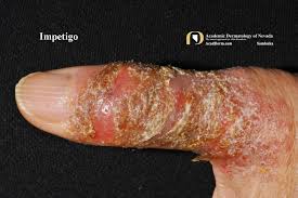 Image result for Impetigo