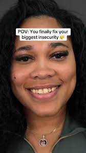 Buck Teeth Transformation Veneers