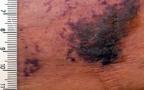 It is a skin disease causing much itchiness. Calciphylaxis Wikipedia