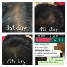 Makanan atasi punca rambut gugur. Penawar Masalah Rambut Gugur Terkini Mawardi Yunus