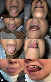 A, B yellow arrows indicating the lesion