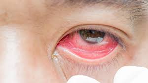 Can You Have a Contact Lens Allergy?