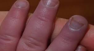Top 10 Reasons For Brittle And Deformed Nails Thehealthsite Com